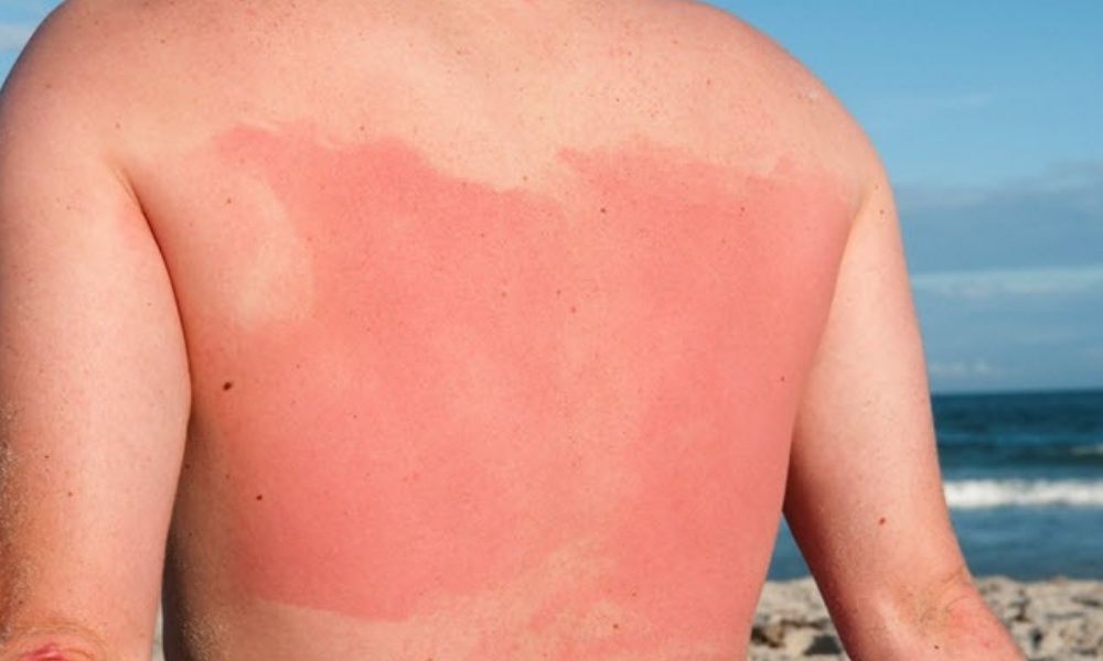 The Link Between Sunburn and Skin Cancer for Those with Blue Eyes and Pink Hair - wide 1